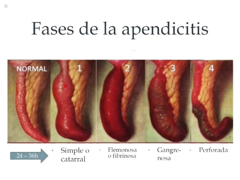 Que pasa despues de que te operan de la apendice