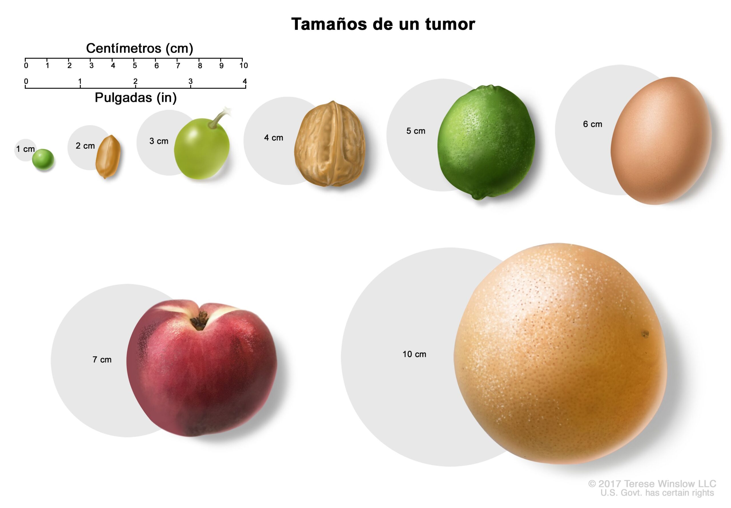 uterine-fibroid-uterus-size-chart